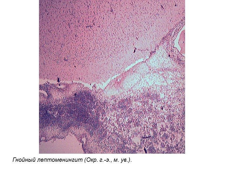 Гнойный лептоменингит (Окр. г.-э., м. ув.).